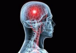 5 أعراض للإصابة بالسكتة الدماغية.. تعرّف عليها