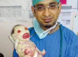 ولادة طفلة غريبة في الهند