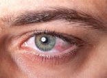 «الصحة» تكشف عن 3 أسباب لـ«احمرار العين»