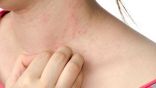 دراسة: الطفح الجلدي قد يكون أحد أعراض “كورونا”‎