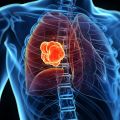 الصحة تشارك في تفعيل التوعية بالشهر العالمي لسرطان الرئة